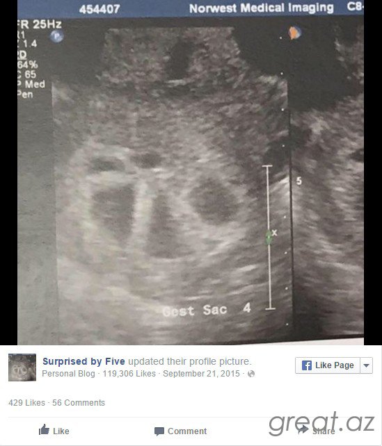 Как это выглядит, если вы беременны пятерняшками (7 фото)