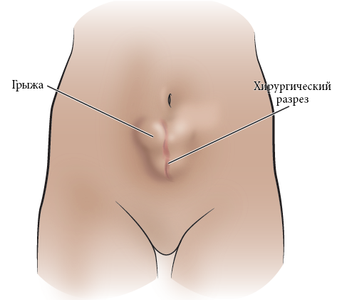 Как быстро избавиться от вздутия живота после еды: проверенные методы
