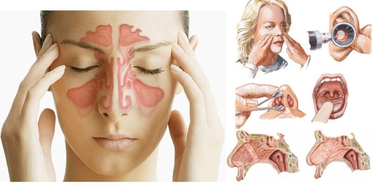 Как вылечить насморк за один день: Проверенные способы от эксперта