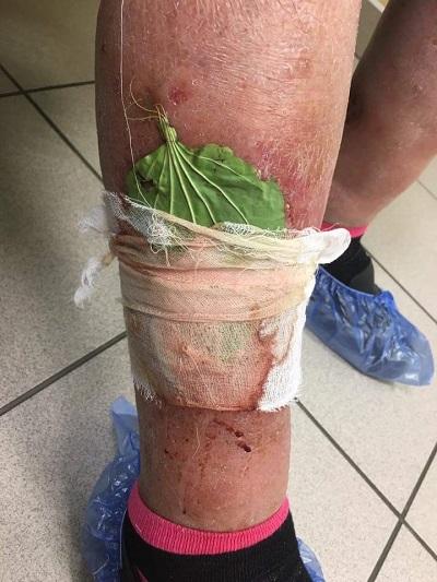 Народные средства от варикоза на ранней стадии