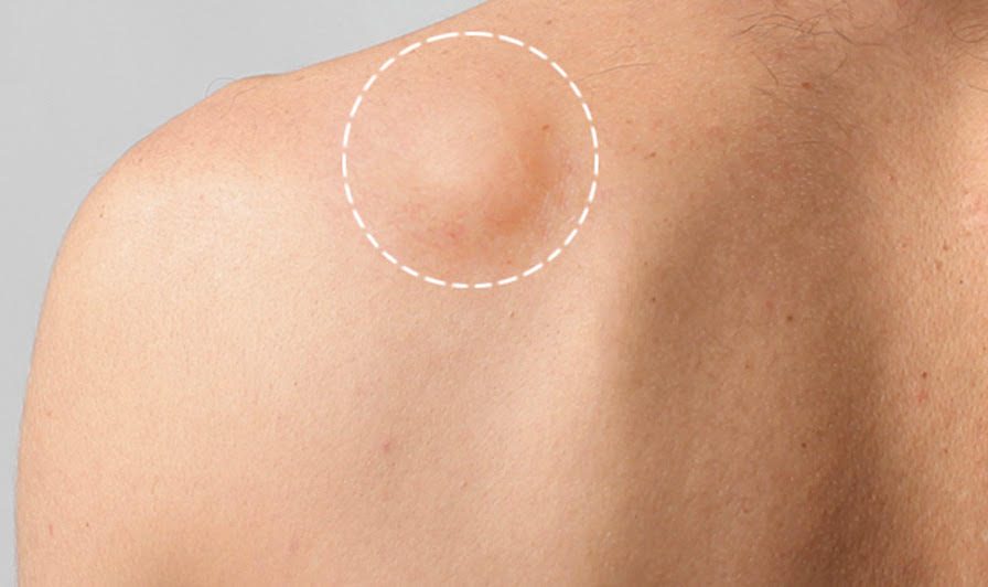 Чем лечить жировик на теле в домашних условиях