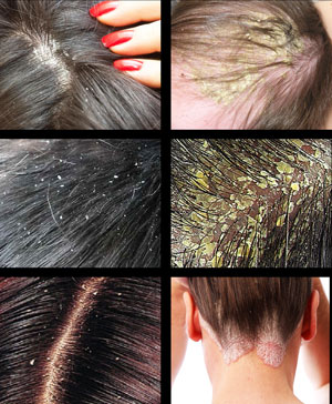 Как избавиться от перхоти в домашних условиях за 1 раз