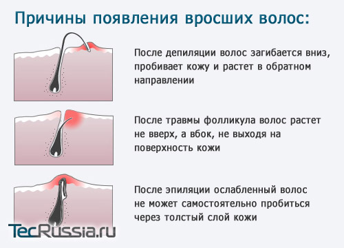 Как избавиться от вросших волос на ногах после эпиляции
