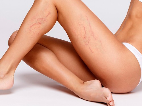 Как укрепить сосуды и вены на ногах народными средствами